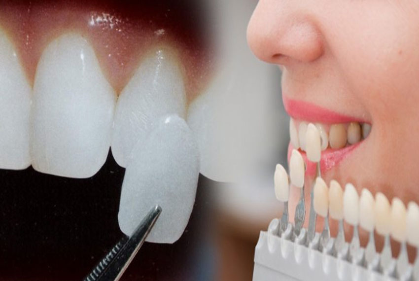 veneers,crown and bridges treatment in Kalol