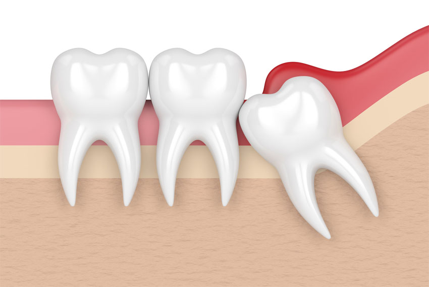 Wisdom Tooth in Kalol