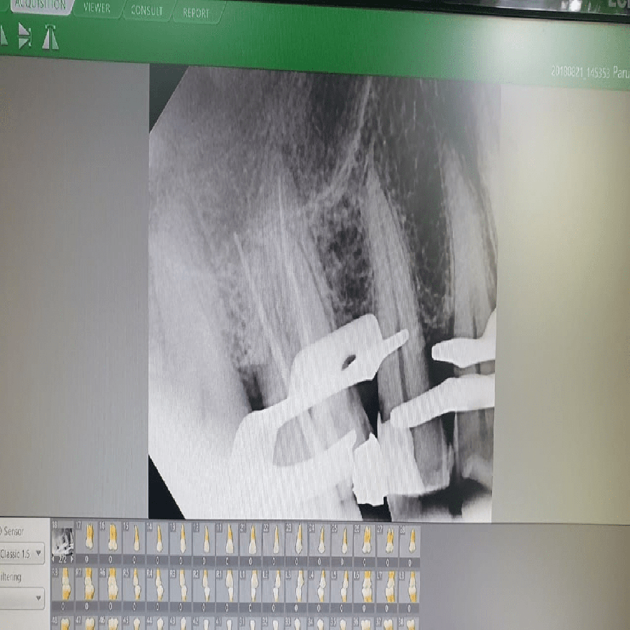 teeth whitening in Kalol