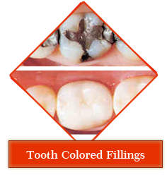 Dental jewellery treatment in Gandhinagar , Dental implants clinic in Gandhinagar , Smile Designing treatment in Gandhinagar , Orthodontic services in Gandhinagar , periodontal dentistry treatment in gandhinagar ,
 root canal treatment in gandhinagar , teeth whitening in gandhinagar , veneers,crown and bridges treatment in gandhinagar ,
 oral surgery in gandhinagar , maxillofacial surgery in gandhinagar