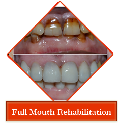 Dental jewellery treatment in Gandhinagar , Dental implants clinic in Gandhinagar , Smile Designing treatment in Gandhinagar , Orthodontic services in Gandhinagar , periodontal dentistry treatment in gandhinagar ,
 root canal treatment in gandhinagar , teeth whitening in gandhinagar , veneers,crown and bridges treatment in gandhinagar ,
 oral surgery in gandhinagar , maxillofacial surgery in gandhinagar